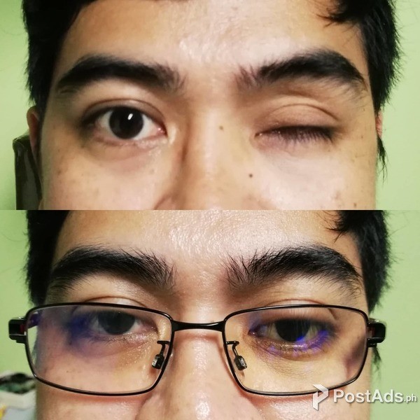 Custom Made Artificial Eye Manila Philippines