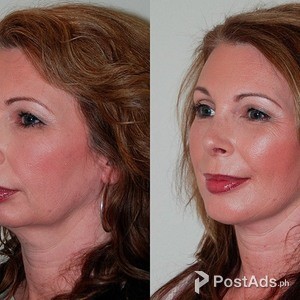 Chin implants | PostAds PH