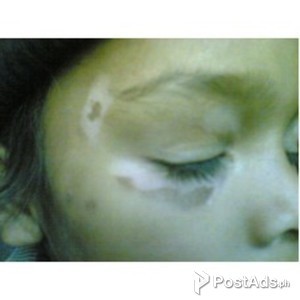 AROGYAM PURE HERBS KIT FOR VITILIGO | PostAds PH