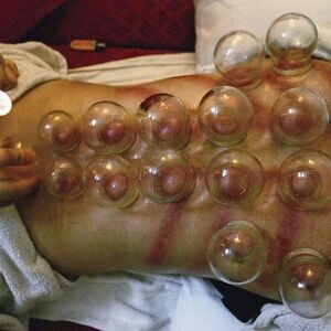 Ventosa Cupping Therapy | PostAds PH