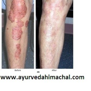 AROGYAM PURE HERBS KIT FOR PSORIASIS | PostAds PH