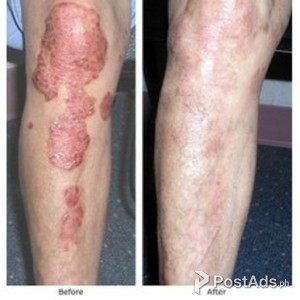 AROGYAM PURE HERBS KIT FOR PSORIASIS | PostAds PH